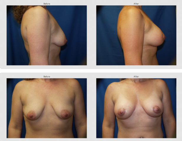 Breast Lift Reduction Holzapfel Lied Plastic Surgery