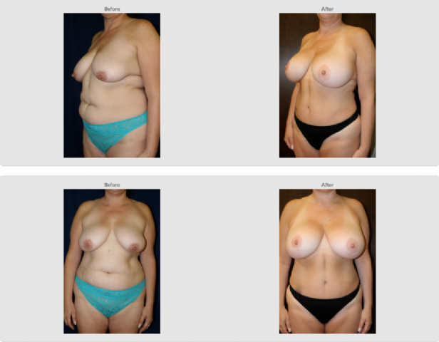 Total Body Lift Holzapfel Lied Plastic Surgery