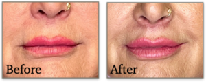 Surgical results of a sub nasal lip lift at 1 month post-procedure. 